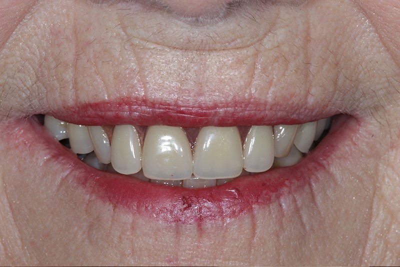 Densurefit For Lower Dentures Clarkesville GA 30523